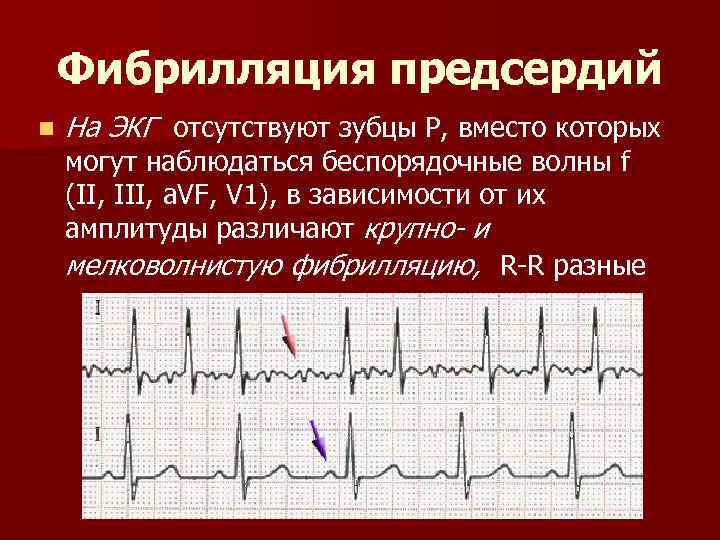 Фибрилляция предсердий n На ЭКГ отсутствуют зубцы Р, вместо которых могут наблюдаться беспорядочные волны