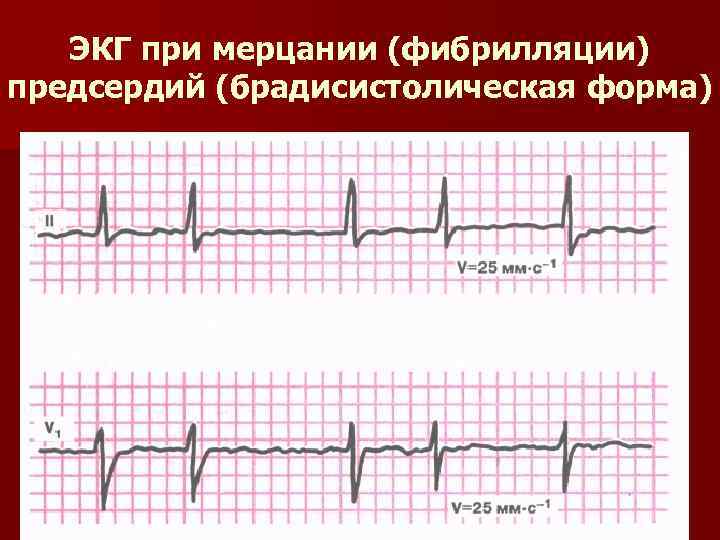 ЭКГ при мерцании (фибрилляции) предсердий (брадисистолическая форма) 