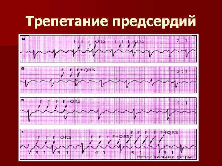 Типы трепетания предсердий. Трепетание предсердий 2:1. Трепетание предсердий с блокадой. Трепетание предсердий с АВ блокадой. Трепетание предсердий и полная АВ блокада.