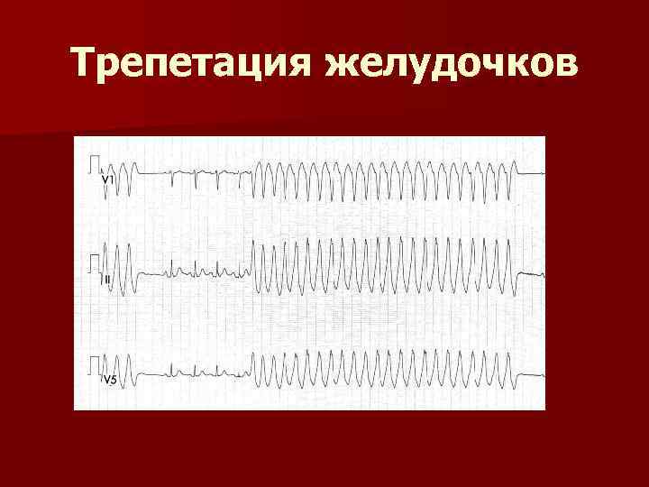 Трепетация желудочков 