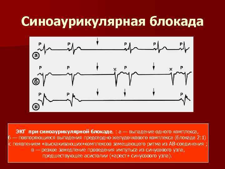 Синоаурикулярная блокада ЭКГ при синоаурикулярной блокаде. : а — выпадение одного комплекса, б —