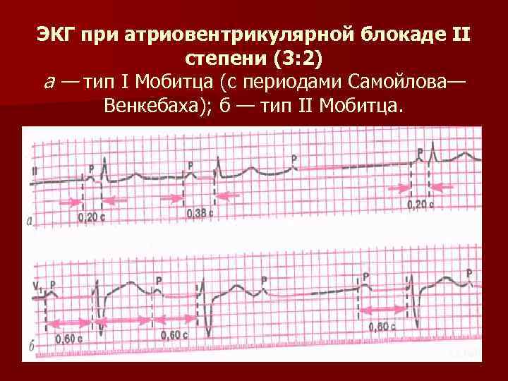 ЭКГ при атриовентрикулярной блокаде II степени (3: 2) а — тип I Мобитца (с