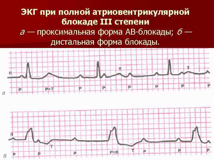 ЭКГ при полной атриовентрикулярной блокаде III степени а — проксимальная форма АВ-блокады; б —