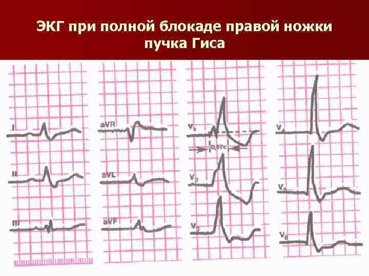 ЭКГ при полной блокаде правой ножки пучка Гиса 