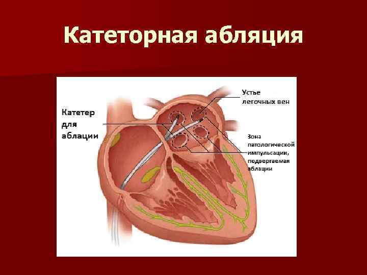 Катеторная абляция 