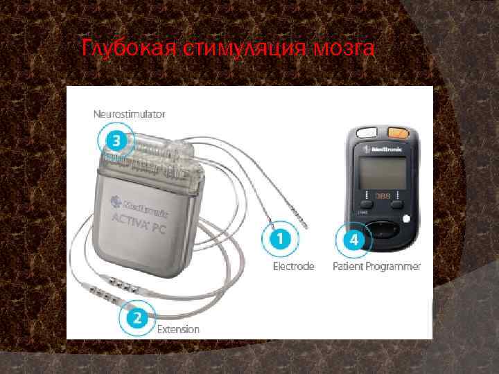 Глубокая стимуляция мозга 