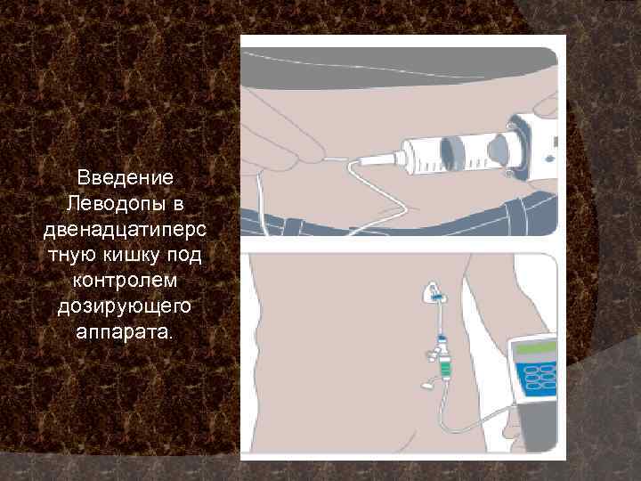 Введение Леводопы в двенадцатиперс тную кишку под контролем дозирующего аппарата. 