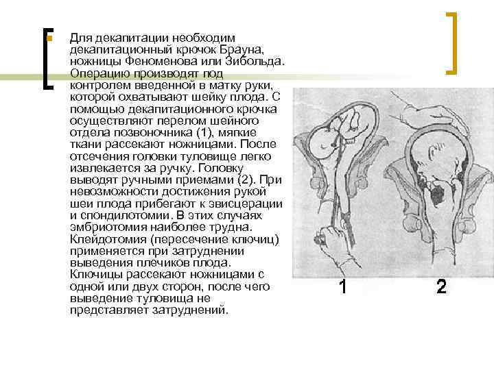 n Для декапитации необходим декапитационный крючок Брауна, ножницы Феноменова или Зибольда. Операцию производят под