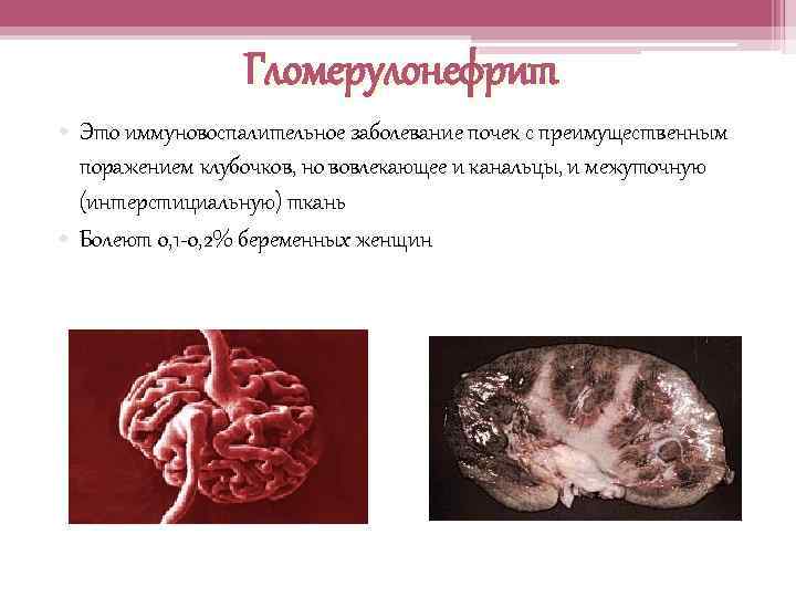 Гломерулонефрит • Это иммуновоспалительное заболевание почек с преимущественным поражением клубочков, но вовлекающее и канальцы,