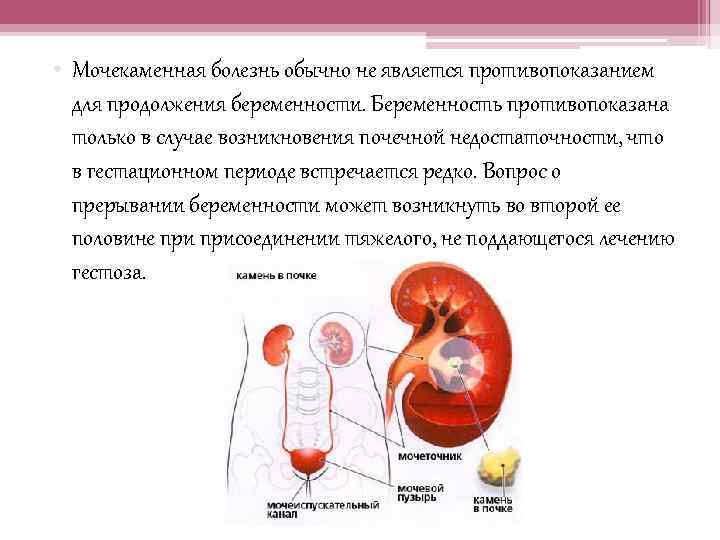 Мочекаменная болезнь осложнения. Мочекаменная болезнь и беременность. Болезни почек мочекаменная болезнь. Мочекаменная болезнь при беременности. Мочекаменная болезнь причины.