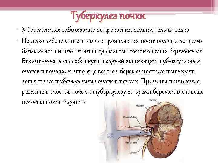 Туберкулез почки • У беременных заболевание встречается сравнительно редко • Нередко заболевание впервые проявляется