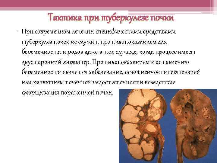 Тактика при туберкулезе почки • При современном лечении специфическими средствами туберкулез почек не служит