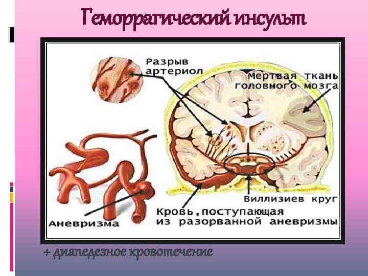 Геморрагический инсульт + диапедезное кровотечение 