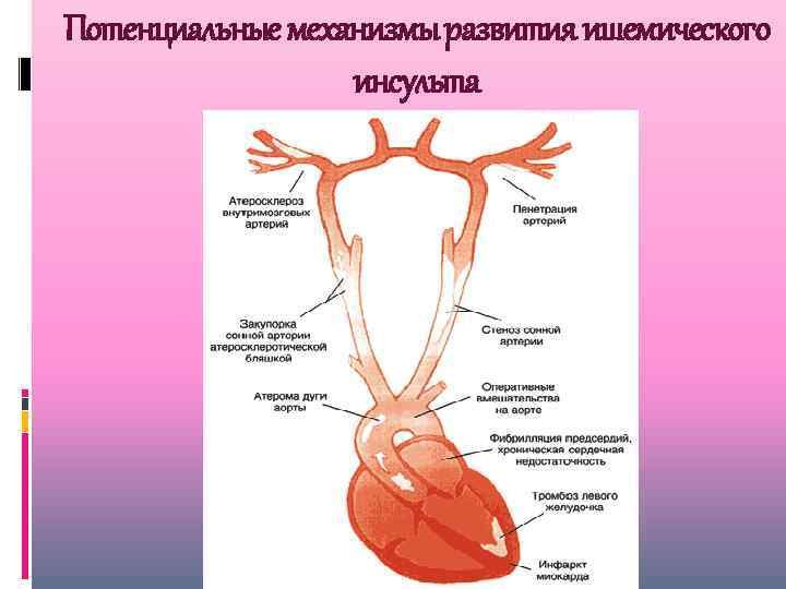 Потенциальные механизмы развития ишемического инсульта 