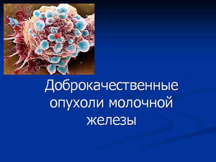 Доброкачественные опухоли молочной железы 