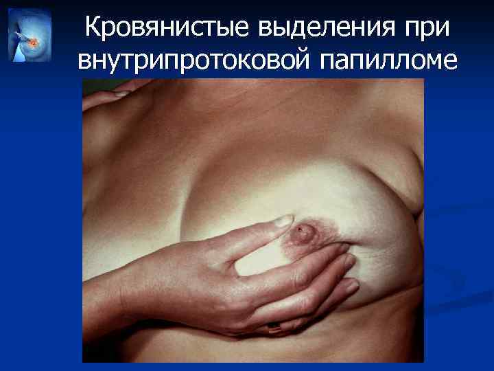 Кровянистые выделения при внутрипротоковой папилломе 