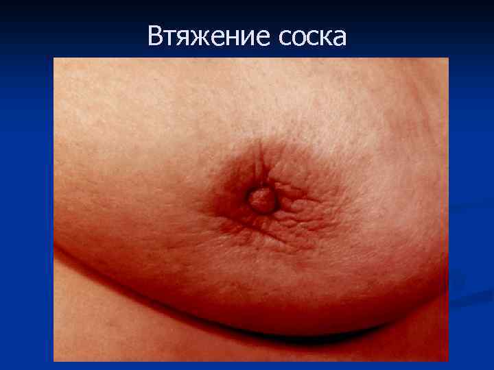 Втяжение соска 