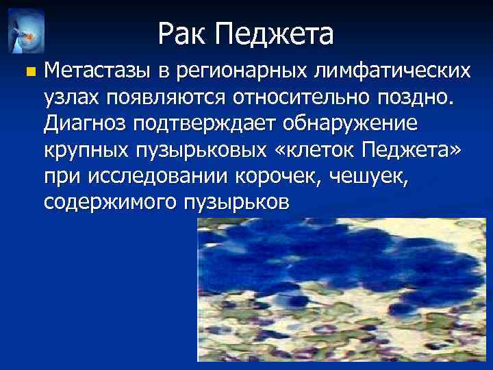 Рак Педжета n Метастазы в регионарных лимфатических узлах появляются относительно поздно. Диагноз подтверждает обнаружение