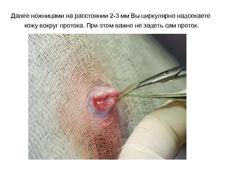Далее ножницами на расстоянии 2 -3 мм Вы циркулярно надсекаете кожу вокруг протока. При