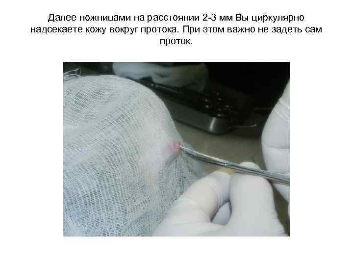 Далее ножницами на расстоянии 2 -3 мм Вы циркулярно надсекаете кожу вокруг протока. При