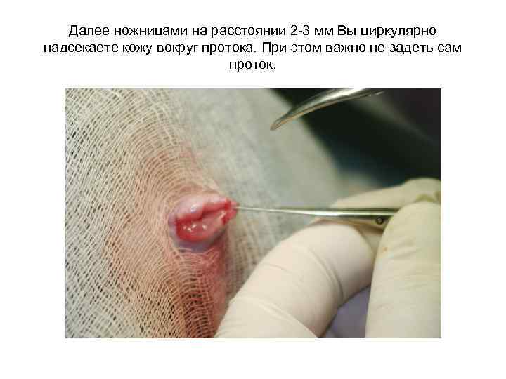 Далее ножницами на расстоянии 2 -3 мм Вы циркулярно надсекаете кожу вокруг протока. При