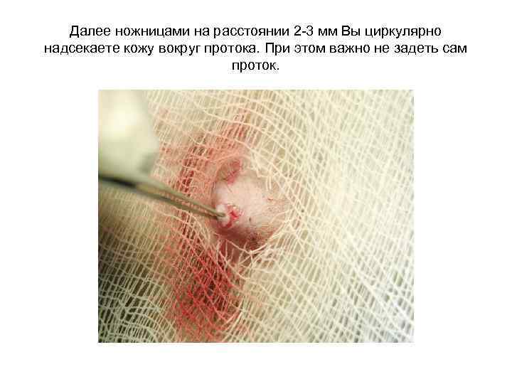 Далее ножницами на расстоянии 2 -3 мм Вы циркулярно надсекаете кожу вокруг протока. При