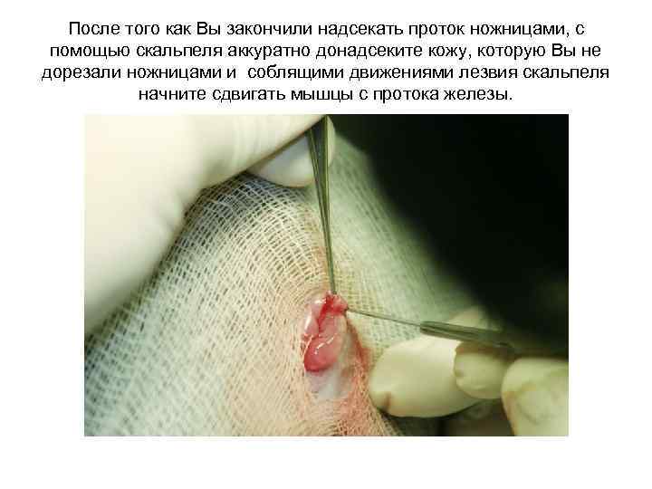 После того как Вы закончили надсекать проток ножницами, с помощью скальпеля аккуратно донадсеките кожу,