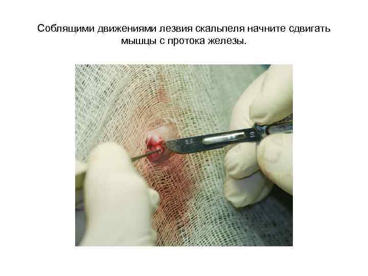 Соблящими движениями лезвия скальпеля начните сдвигать мышцы с протока железы. 