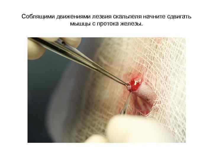 Соблящими движениями лезвия скальпеля начните сдвигать мышцы с протока железы. 