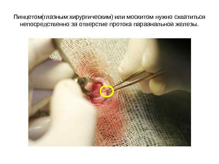 Пинцетом(глазным хирургическим) или москитом нужно схватиться непосредственно за отверстие протока параанальной железы. 