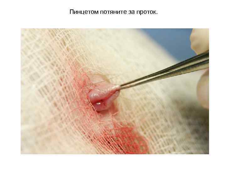 Пинцетом потяните за проток. 