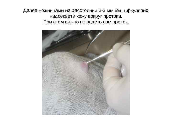 Далее ножницами на расстоянии 2 -3 мм Вы циркулярно надсекаете кожу вокруг протока. При