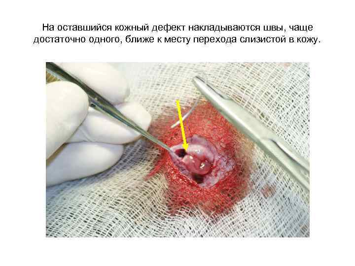 На оставшийся кожный дефект накладываются швы, чаще достаточно одного, ближе к месту перехода слизистой