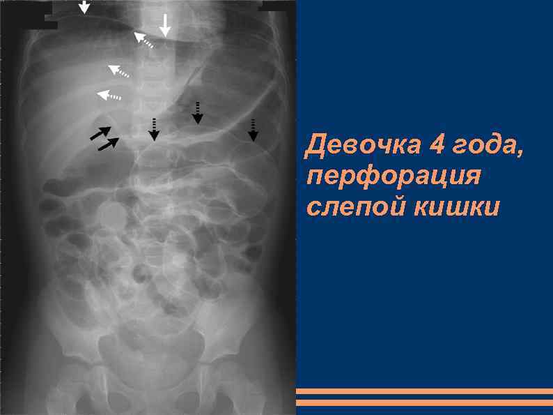 Девочка 4 года, перфорация слепой кишки 