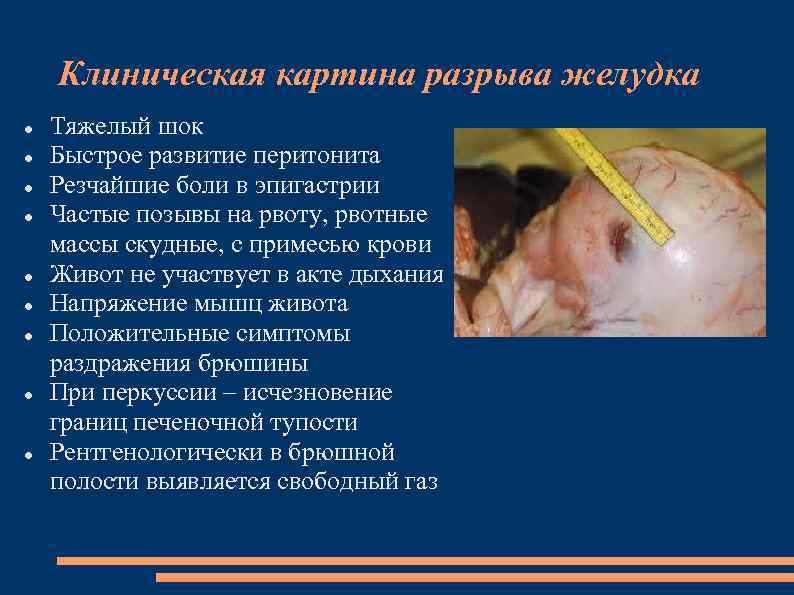 Клиническая картина разрыва желудка Тяжелый шок Быстрое развитие перитонита Резчайшие боли в эпигастрии Частые