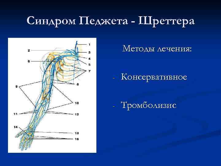 Синдром Педжета - Шреттера Методы лечения: - Консервативное - Тромболизис 