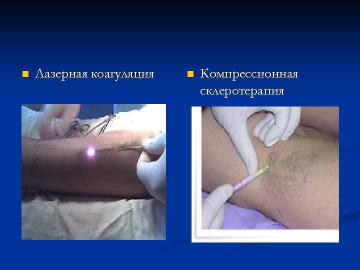 n Лазерная коагуляция n Компрессионная склеротерапия 