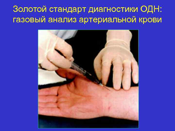 Золотой стандарт диагностики ОДН: газовый анализ артериальной крови 