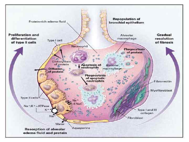 Фаза разрешения ОРДСфибропролиферация 