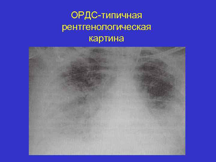 ОРДС-типичная рентгенологическая картина 
