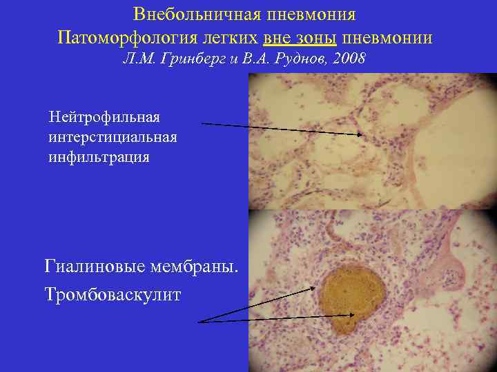 Внебольничная пневмония Патоморфология легких вне зоны пневмонии Л. М. Гринберг и В. А. Руднов,