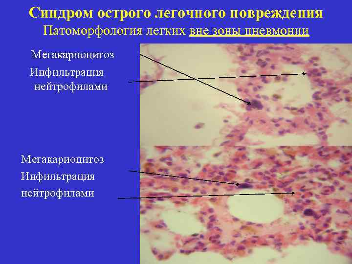 Симптом бенье мещерского фото