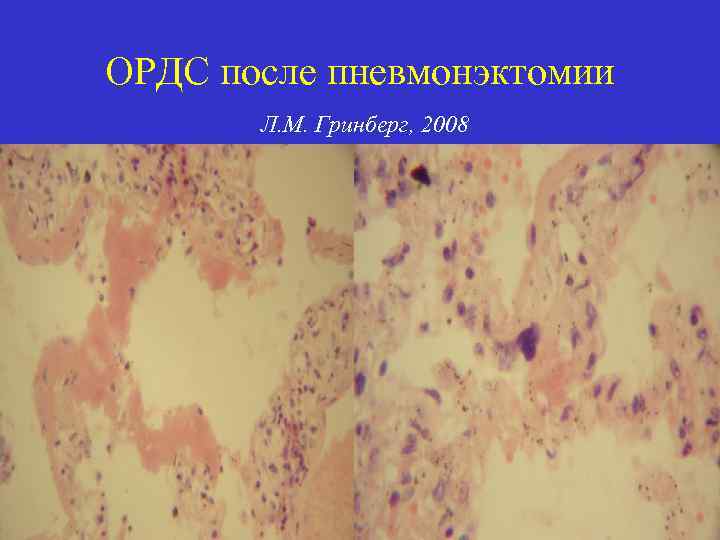 ОРДС после пневмонэктомии Л. М. Гринберг, 2008 