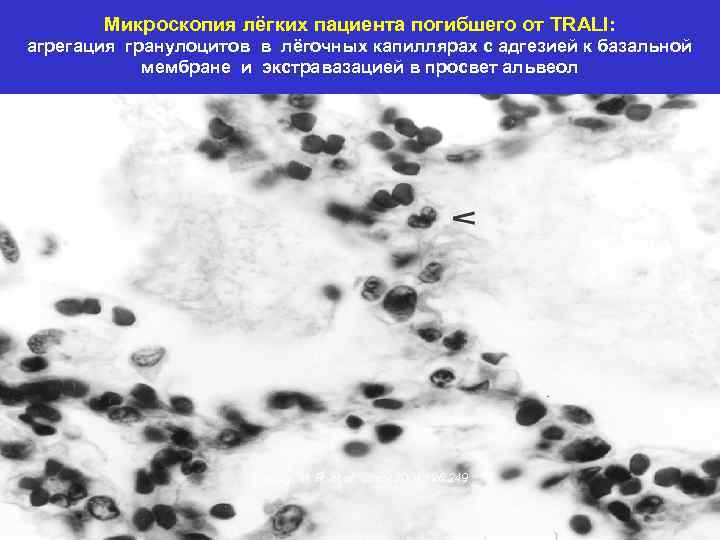 Микроскопия лёгких пациента погибшего от TRALI: агрегация гранулоцитов в лёгочных капиллярах с адгезией к