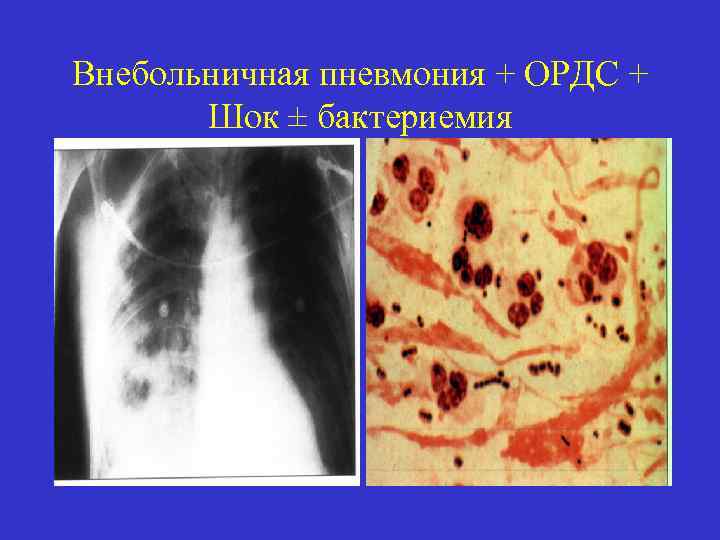 Внебольничная пневмония + ОРДС + Шок ± бактериемия 