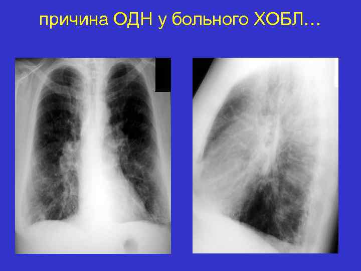 причина ОДН у больного ХОБЛ… 