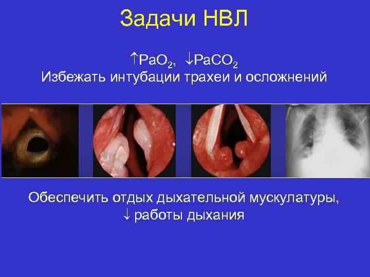 Задачи НВЛ Ра. О 2, Ра. СО 2 Избежать интубации трахеи и осложнений Обеспечить