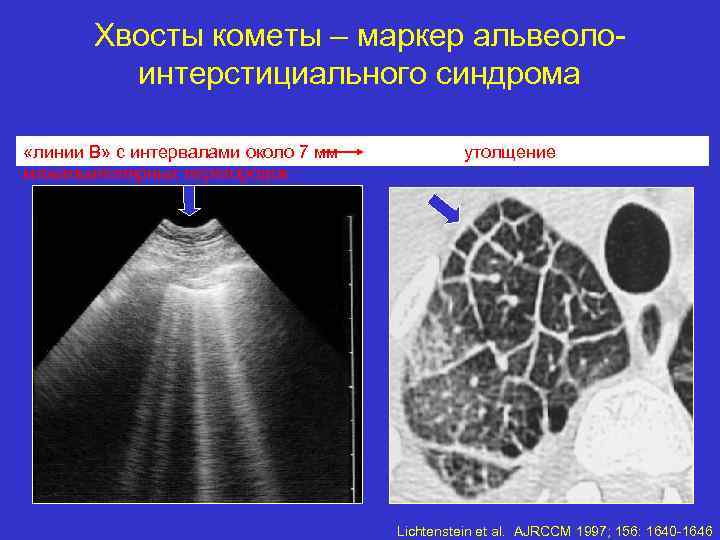 Хвосты кометы – маркер альвеолоинтерстициального синдрома «линии B» с интервалами около 7 мм утолщение