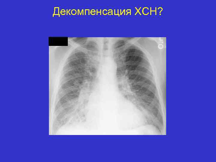 Декомпенсация ХСН? 