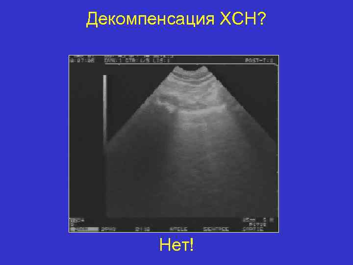 Декомпенсация ХСН? Нет! 